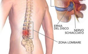 ernia-del-disco